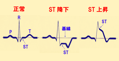 冠動脈けいれんとは何ですか?