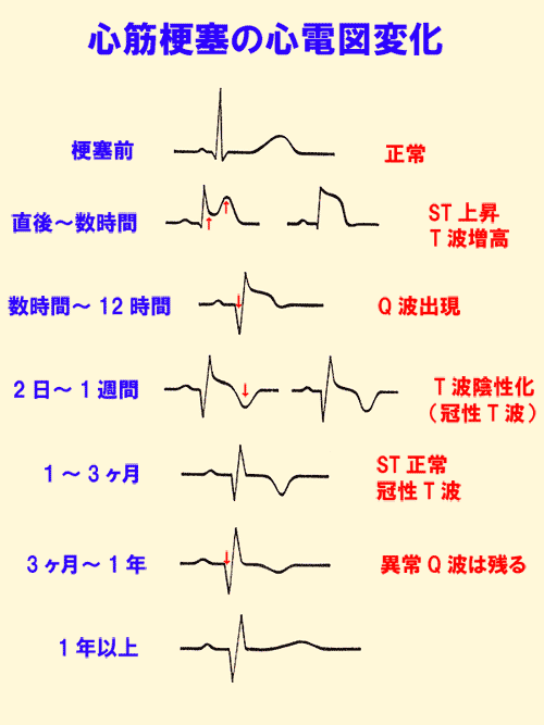 心筋梗塞の心電図変化
