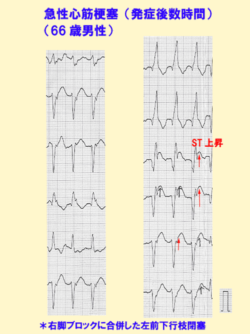 急性心筋梗塞（発症後数時間）の心電図