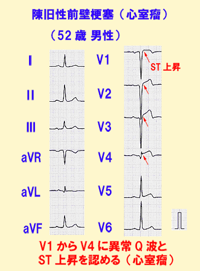 陳旧性前壁梗塞（心室瘤）の心電図