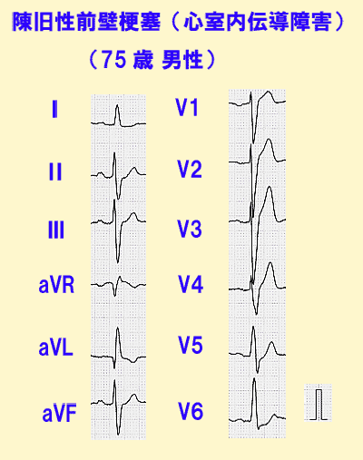 陳旧性前壁梗塞（心室内伝導障害）の心電図
