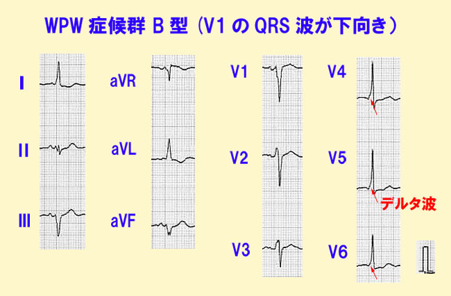 WPW症候群B型（V1のQRS波が下向き）の心電図