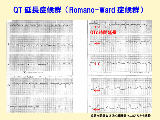 ロマノ-ワード症候群の心電図
