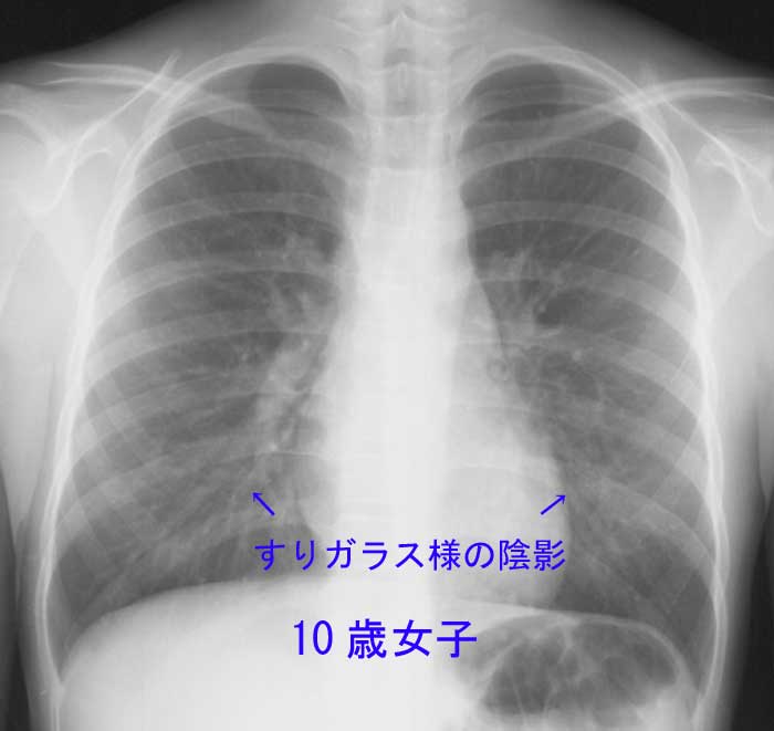 マイコプラズマ肺炎のレントゲン写真