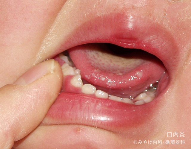 ヘルペス性歯肉口内炎-写真03