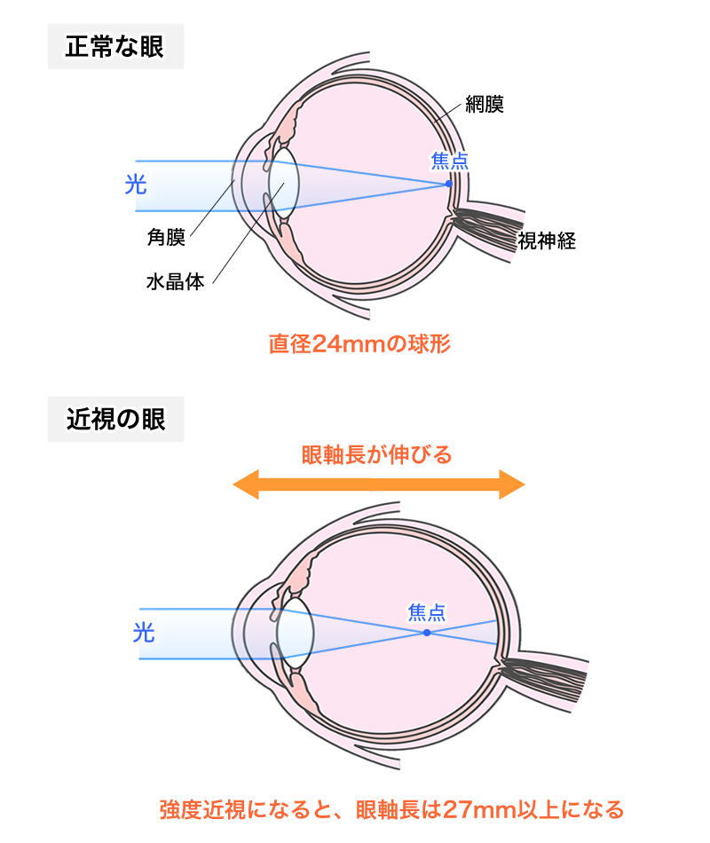正常な目と強度近視の目