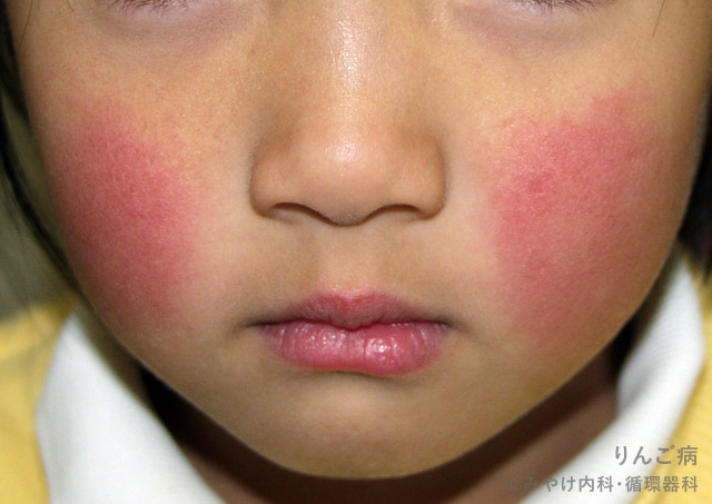 成人の伝染性皮膚疾患