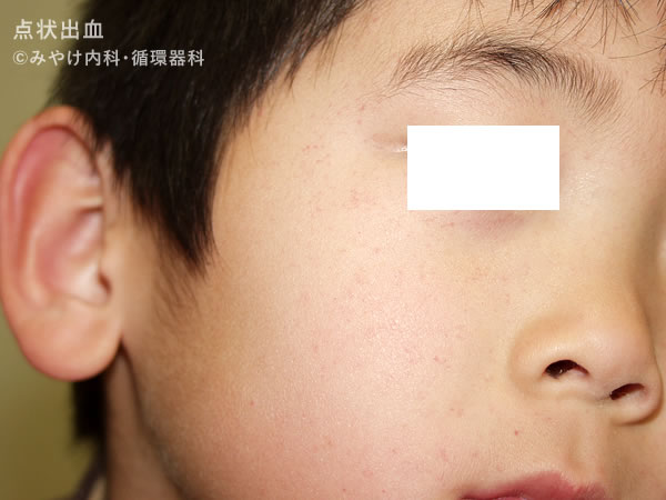 点状出血に合併症はありますか?