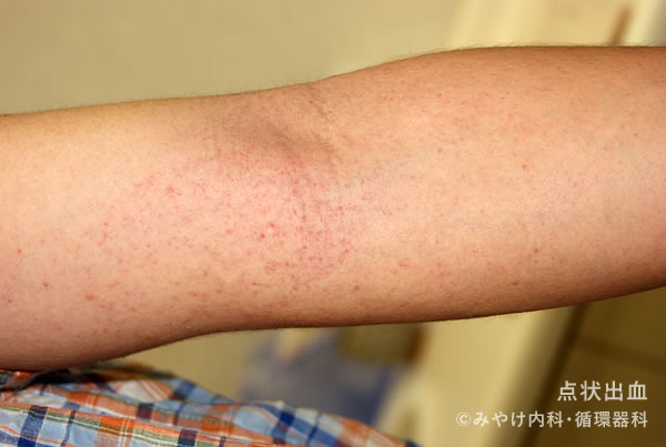 点状出血の一般的な原因