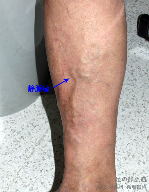 足の静脈瘤-写真1