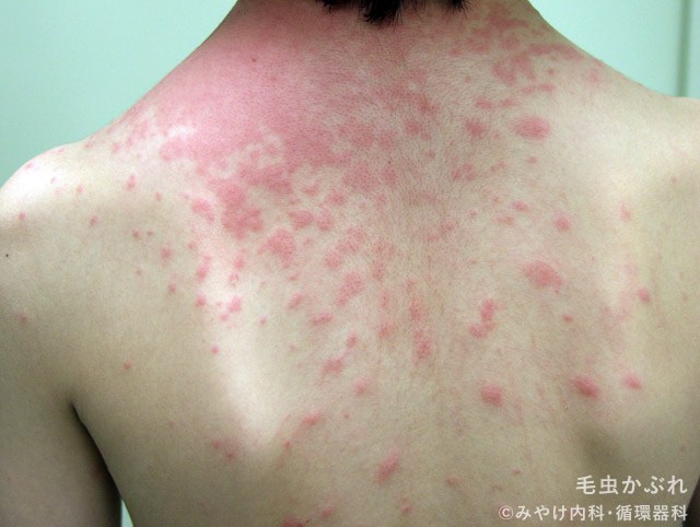 出血性おむつかぶれの原因