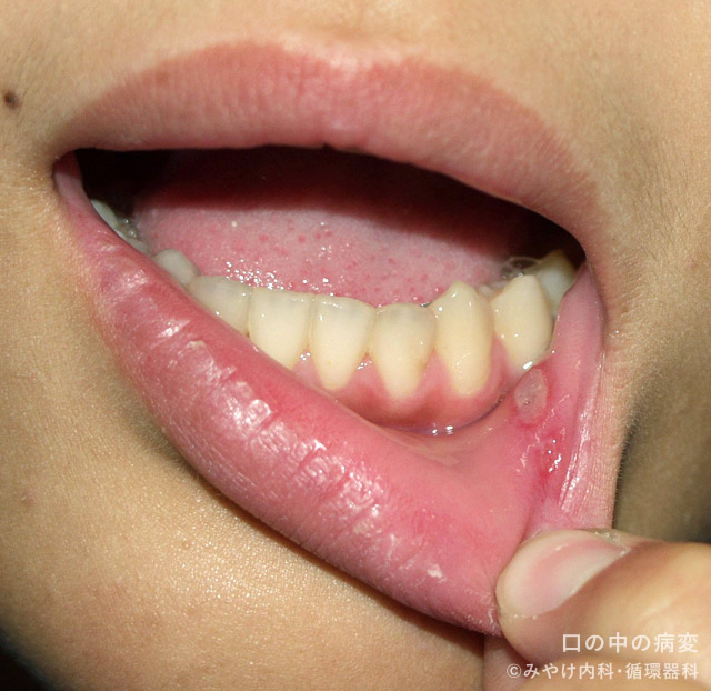 口の中の病変-写真1