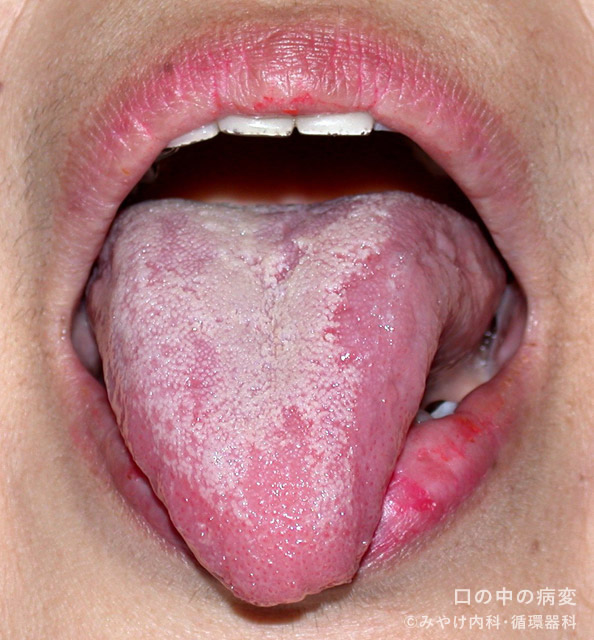 口の中の病変-写真5