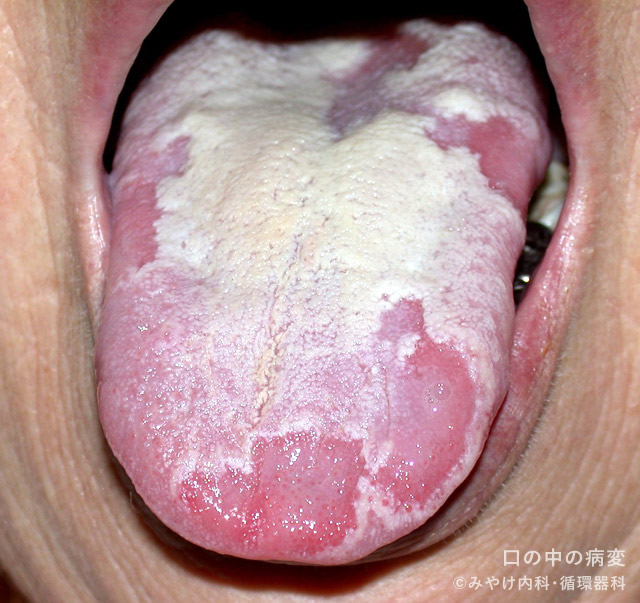口の中の病変-写真6