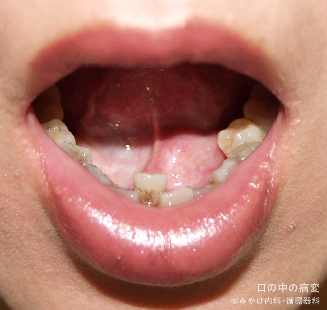 口の中の病変-写真7