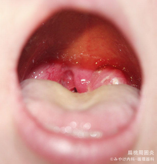 （写真3）扁桃周囲炎、扁桃周囲膿瘍