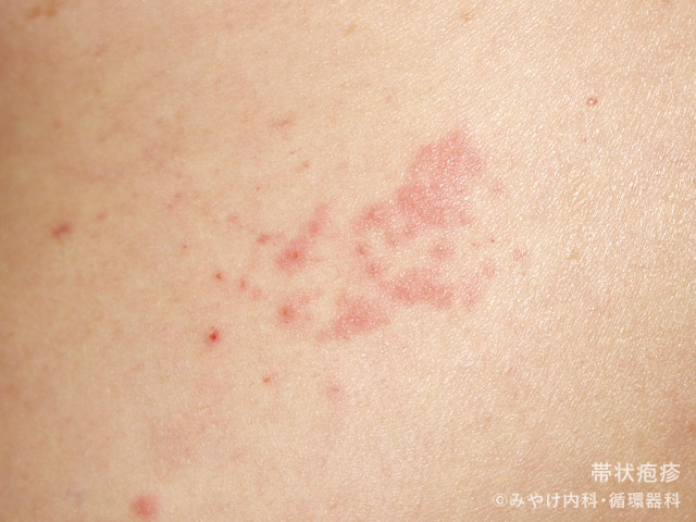 帯状疱疹と間違われる可能性のあるものは何ですか?