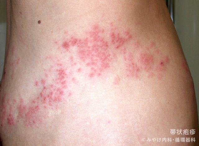 （写真5）帯状疱疹
