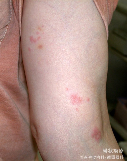 （写真6）帯状疱疹